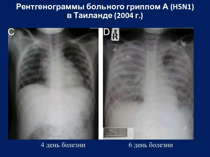 Рентгенограммы больного гриппом А (H5N1) в Таиланде (2004 г.) 4 день болезни 6 день болезни