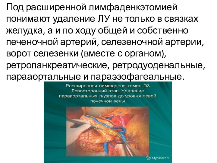 Под расширенной лимфаденкэтомией понимают удаление ЛУ не только в связках желудка, а и