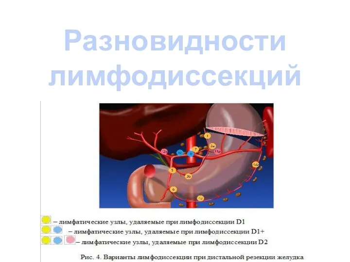 Разновидности лимфодиссекций