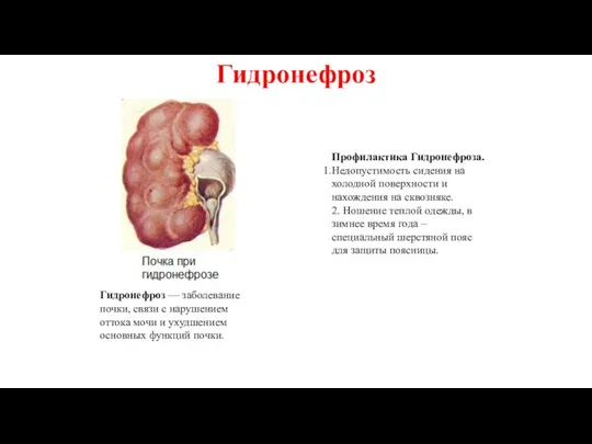 Гидронефроз — заболевание почки, связи с нарушением оттока мочи и ухудшением основных функций