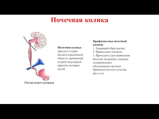 Почечная колика Почечная колика – приступ острых болей в поясничной области, вызванный острой