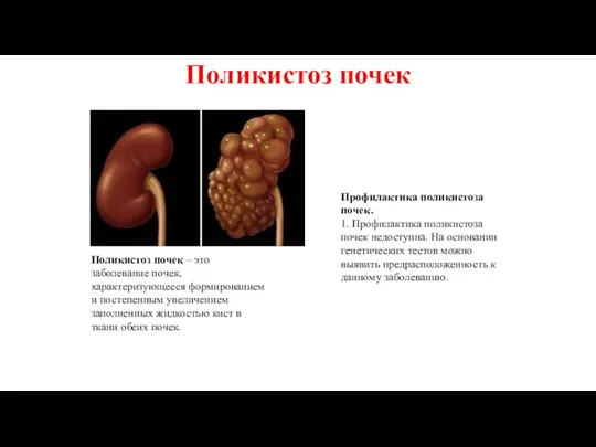 Поликистоз почек – это заболевание почек, характеризующееся формированием и постепенным увеличением заполненных жидкостью