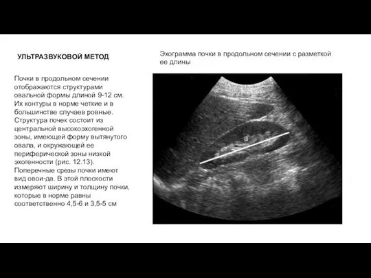 УЛЬТРАЗВУКОВОЙ МЕТОД Почки в продольном сечении отображаются структурами овальной формы длиной 9-12 см.