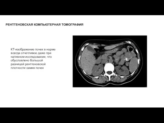 РЕНТГЕНОВСКАЯ КОМПЬЮТЕРНАЯ ТОМОГРАФИЯ КТ-изображение почек в норме всегда отчетливое даже при нативном исследовании,