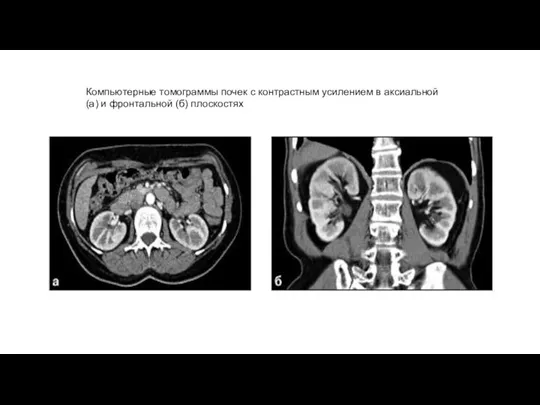 Компьютерные томограммы почек с контрастным усилением в аксиальной (а) и фронтальной (б) плоскостях