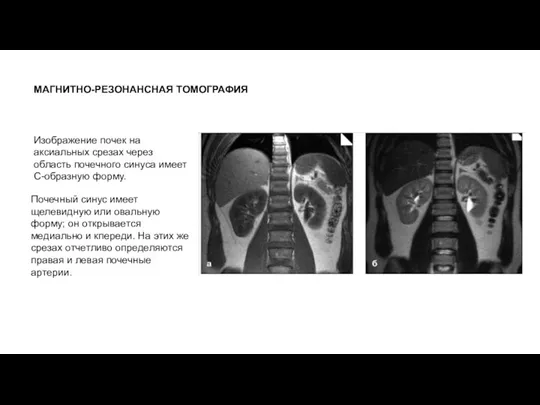 МАГНИТНО-РЕЗОНАНСНАЯ ТОМОГРАФИЯ Изображение почек на аксиальных срезах через область почечного синуса имеет С-образную