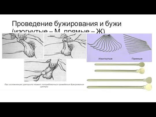 Проведение бужирования и бужи(изогнутые – М, прямые – Ж)