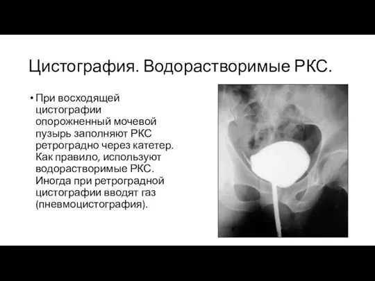 Цистография. Водорастворимые РКС. При восходящей цистографии опорожненный мочевой пузырь заполняют РКС ретроградно через