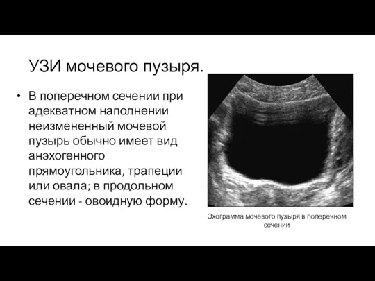 УЗИ мочевого пузыря. В поперечном сечении при адекватном наполнении неизмененный