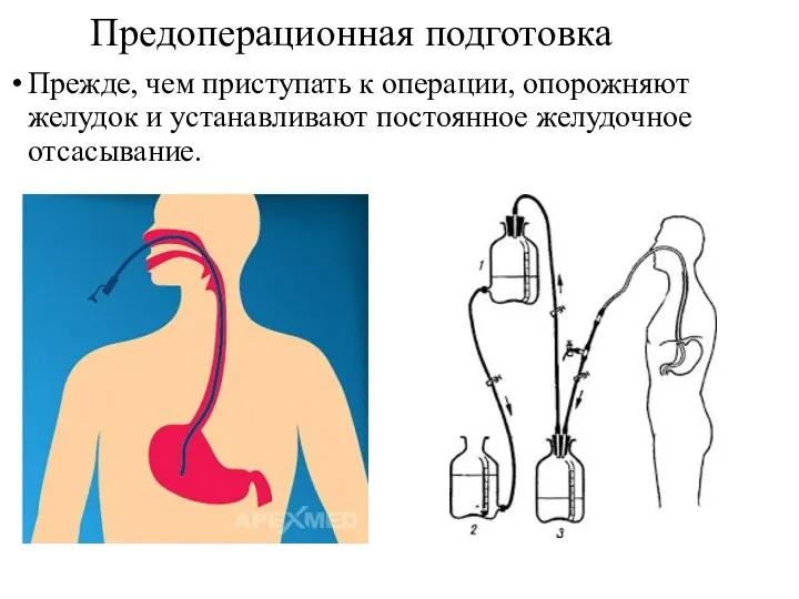 Предоперационная подготовка Прежде, чем приступать к операции, опорожняют желудок и устанавливают постоянное желудочное отсасывание.