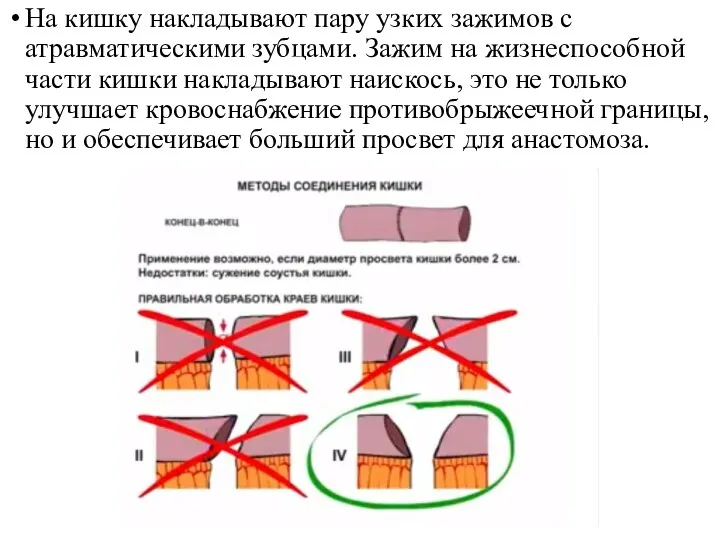 На кишку накладывают пару узких зажимов с атравматическими зубцами. Зажим