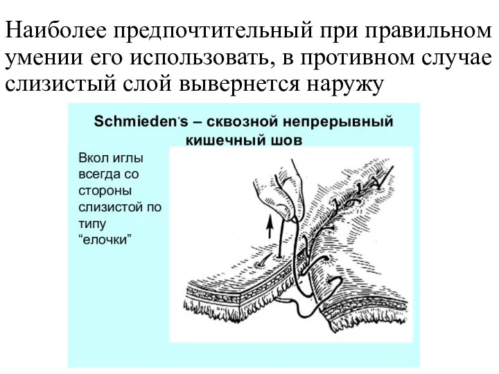 Наиболее предпочтительный при правильном умении его использовать, в противном случае слизистый слой вывернется наружу