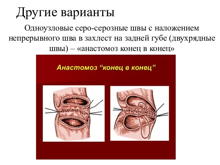 Другие варианты Одноузловые серо-серозные швы с наложением непрерывного шва в