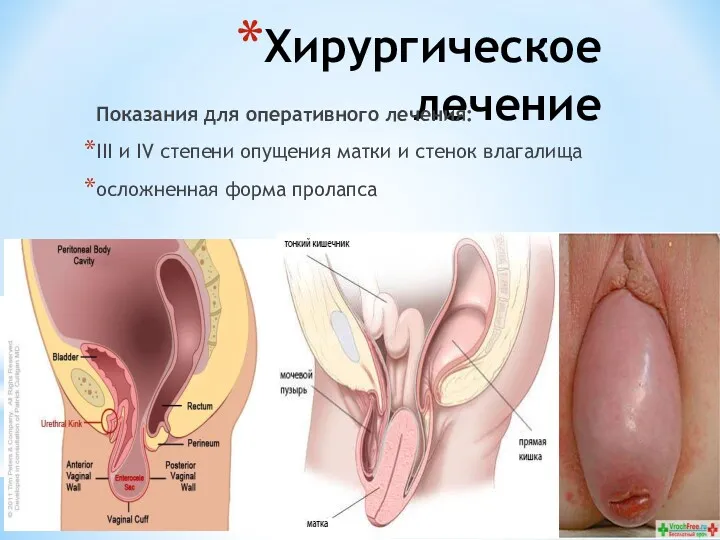 Хирургическое лечение Показания для оперативного лечения: III и IV степени