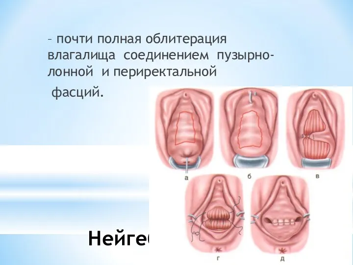 Кольпоклейзис (операция Нейгебауэра – Лефора) – почти полная облитерация влагалища соединением пузырно-лонной и периректальной фасций.