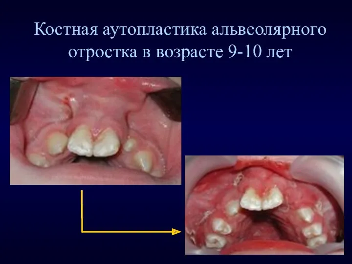 Костная аутопластика альвеолярного отростка в возрасте 9-10 лет