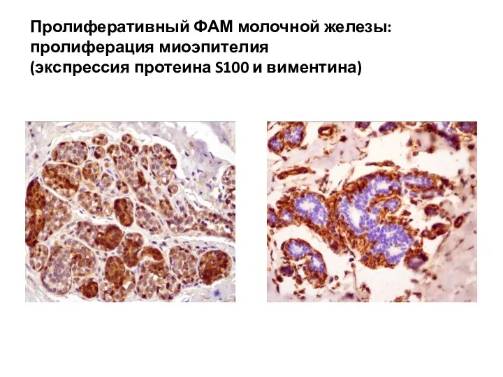 Пролиферативный ФАМ молочной железы: пролиферация миоэпителия (экспрессия протеина S100 и виментина)