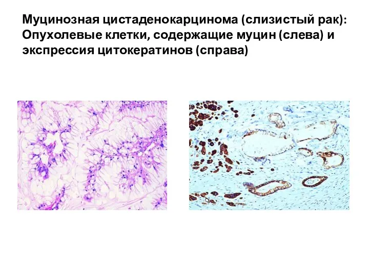 Муцинозная цистаденокарцинома (слизистый рак): Опухолевые клетки, содержащие муцин (слева) и экспрессия цитокератинов (справа)