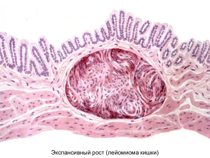 Экспансивный рост (лейомиома кишки)