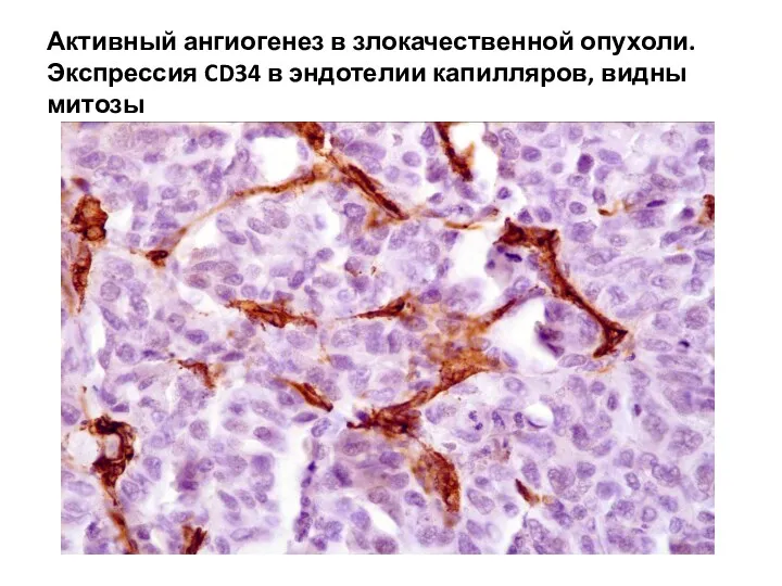 Активный ангиогенез в злокачественной опухоли. Экспрессия CD34 в эндотелии капилляров, видны митозы