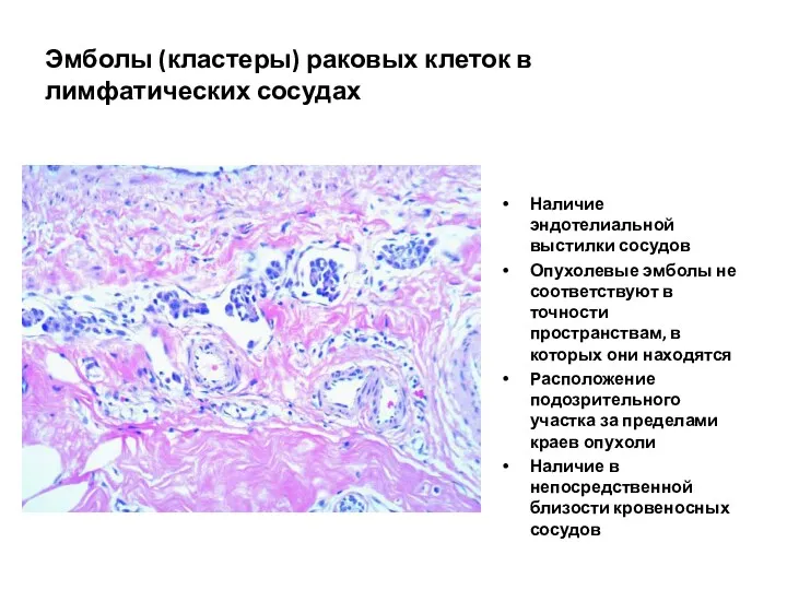 Эмболы (кластеры) раковых клеток в лимфатических сосудах Наличие эндотелиальной выстилки