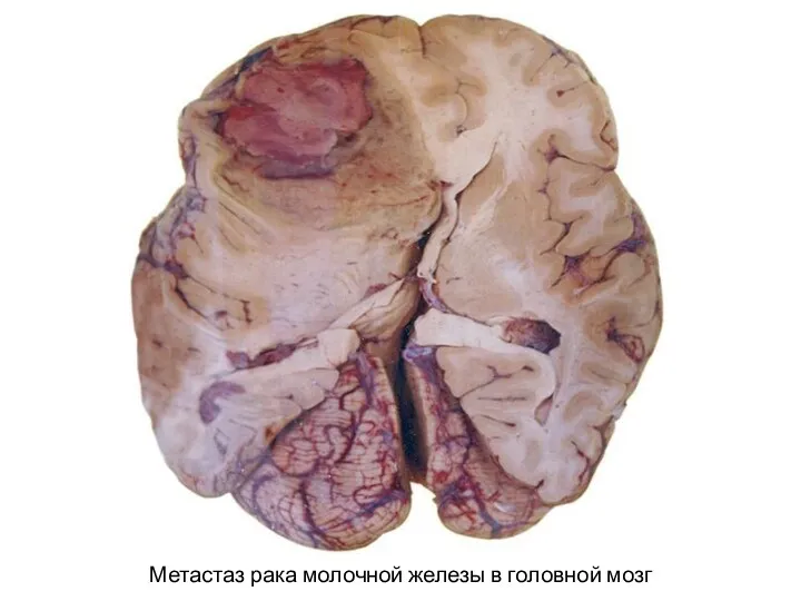 Метастаз рака молочной железы в головной мозг