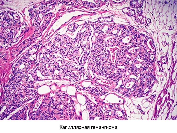 Капиллярная гемангиома