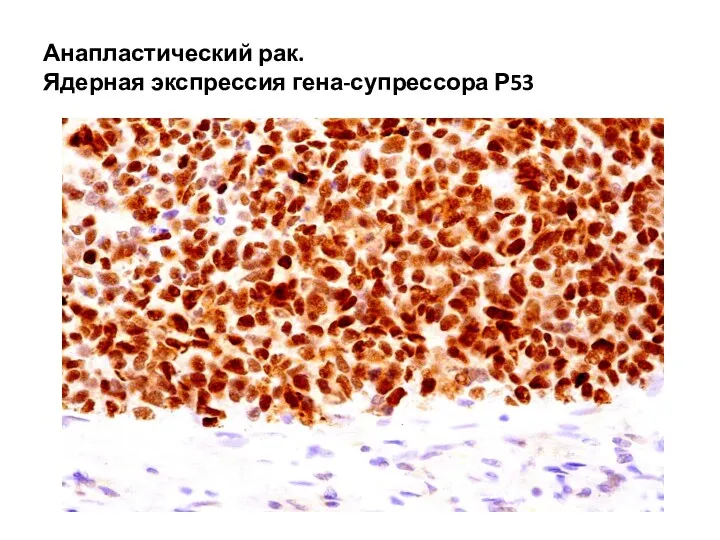 Анапластический рак. Ядерная экспрессия гена-супрессора Р53