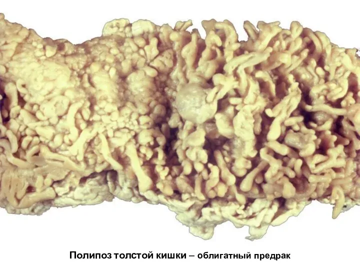 Полипоз толстой кишки – облигатный предрак