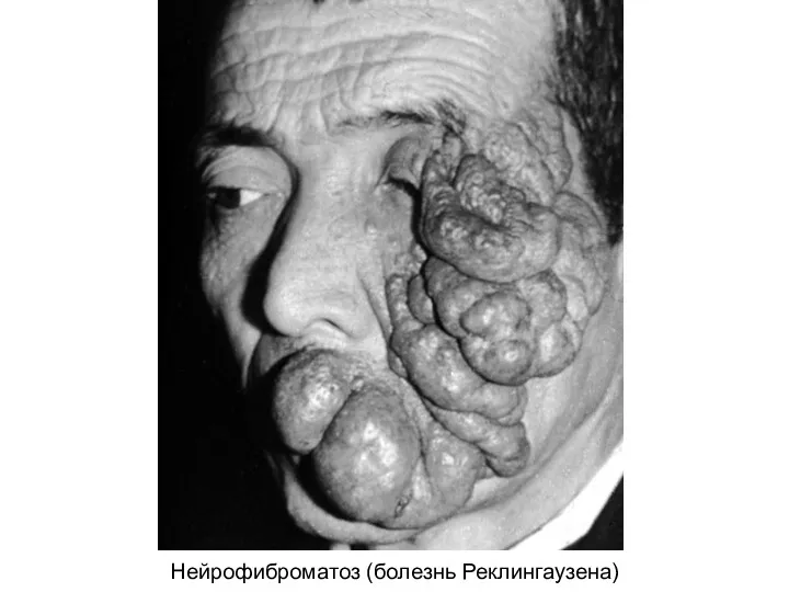 Нейрофиброматоз (болезнь Реклингаузена)