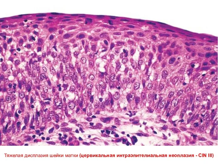 Тяжелая дисплазия шейки матки (цервикальная интраэпителиальная неоплазия - CIN III)