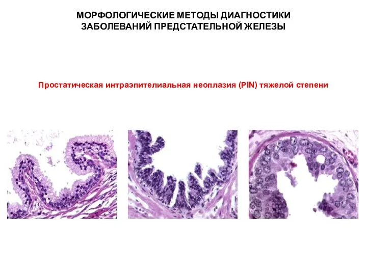 МОРФОЛОГИЧЕСКИЕ МЕТОДЫ ДИАГНОСТИКИ ЗАБОЛЕВАНИЙ ПРЕДСТАТЕЛЬНОЙ ЖЕЛЕЗЫ Простатическая интраэпителиальная неоплазия (PIN) тяжелой степени