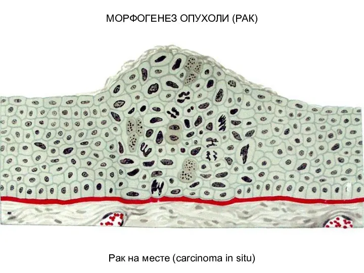 МОРФОГЕНЕЗ ОПУХОЛИ (РАК) Рак на месте (carcinoma in situ)