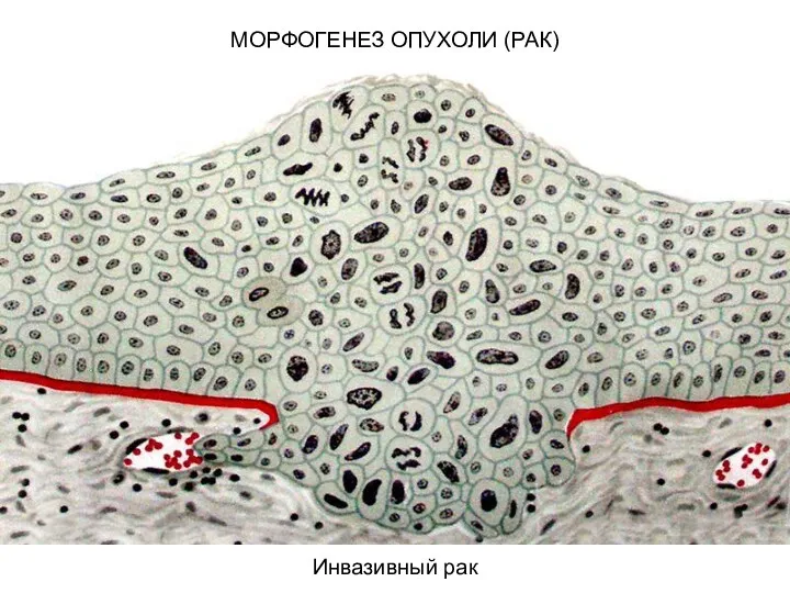 МОРФОГЕНЕЗ ОПУХОЛИ (РАК) Инвазивный рак