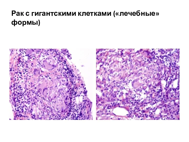 Рак с гигантскими клетками («лечебные» формы)