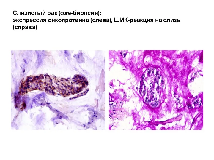 Слизистый рак (core-биопсия): экспрессия онкопротеина (слева), ШИК-реакция на слизь (справа)