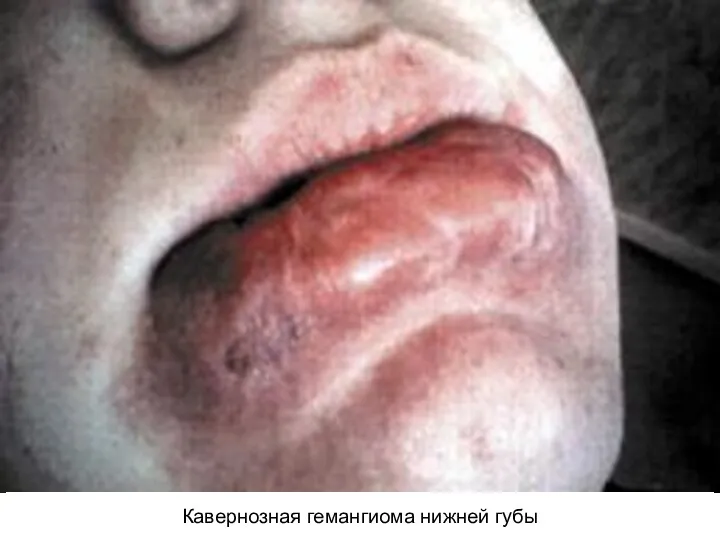 Кавернозная гемангиома нижней губы