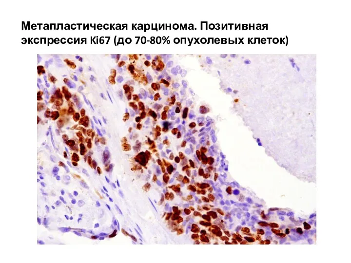 Метапластическая карцинома. Позитивная экспрессия Ki67 (до 70-80% опухолевых клеток)