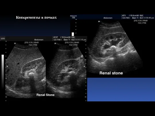 Конкременты в почках