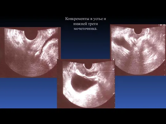 Конкременты в устье и нижней трети мочеточника.