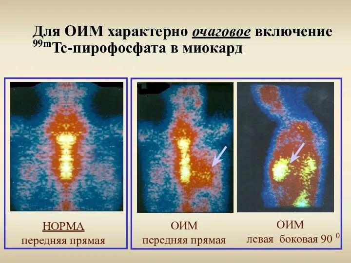 Для ОИМ характерно очаговое включение 99mTc-пирофосфата в миокард ОИМ передняя