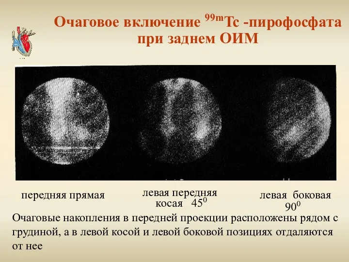 Очаговое включение 99mTc -пирофосфата при заднем ОИМ левая передняя косая