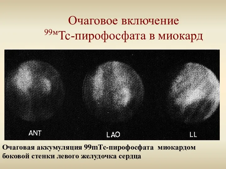 Очаговое включение 99мТс-пирофосфата в миокард Очаговая аккумуляция 99mТс-пирофосфата миокардом боковой стенки левого желудочка сердца