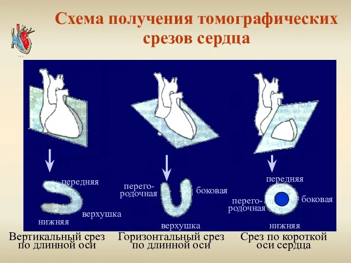 Схема получения томографических срезов сердца передняя верхушка нижняя перего- родочная