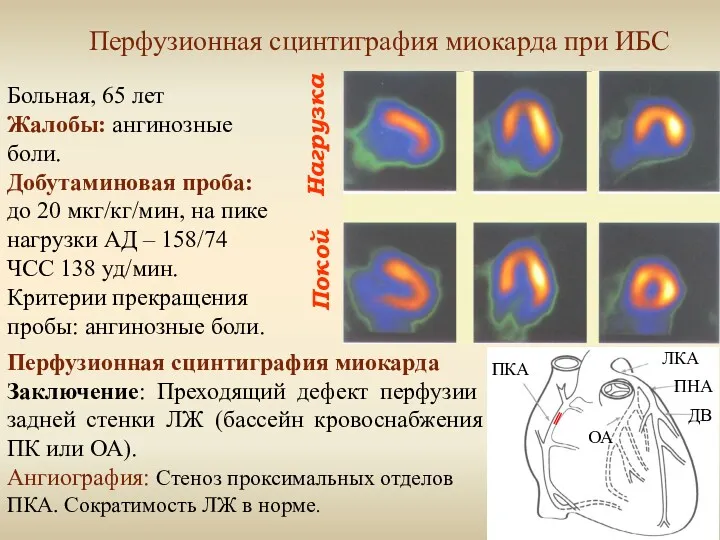 Нагрузка Покой Перфузионная сцинтиграфия миокарда при ИБС Больная, 65 лет