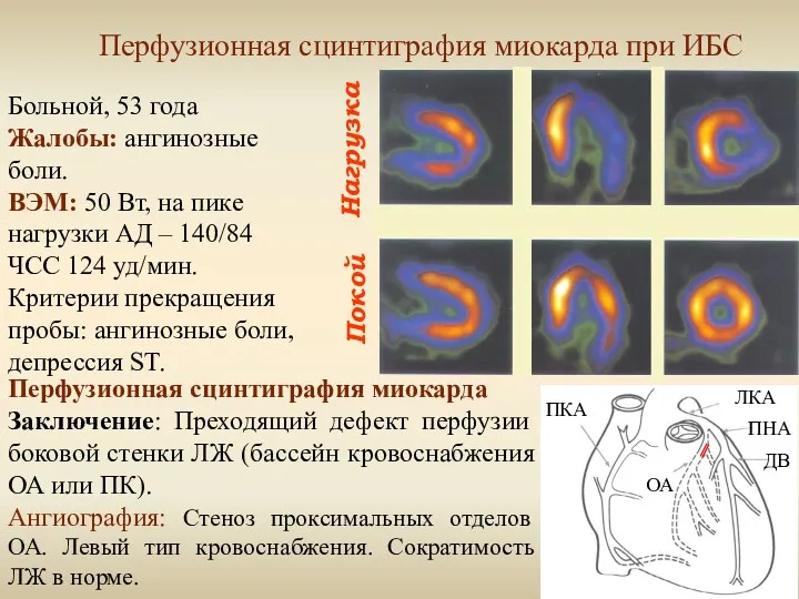 Нагрузка Покой Перфузионная сцинтиграфия миокарда при ИБС Больной, 53 года