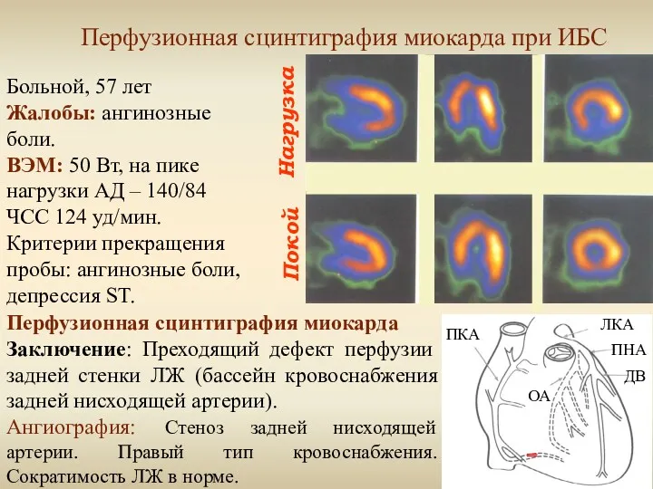 Нагрузка Покой Перфузионная сцинтиграфия миокарда при ИБС Больной, 57 лет