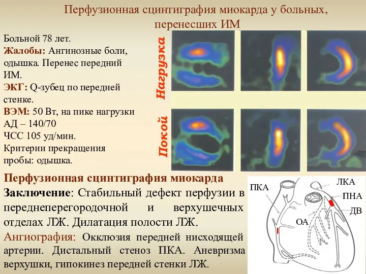 Нагрузка Покой Перфузионная сцинтиграфия миокарда у больных, перенесших ИМ Больной