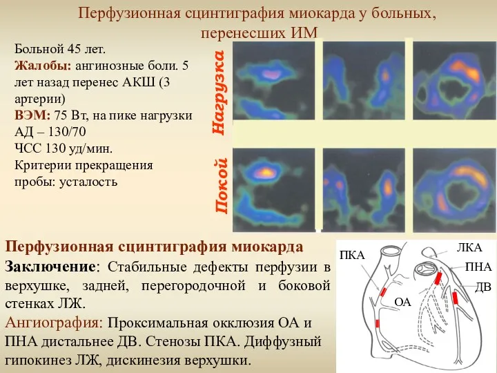 Нагрузка Покой Перфузионная сцинтиграфия миокарда у больных, перенесших ИМ Больной