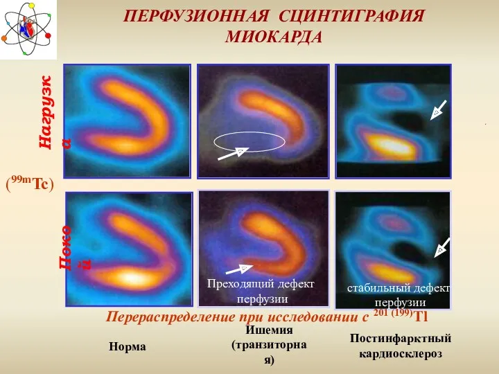 ПЕРФУЗИОННАЯ СЦИНТИГРАФИЯ МИОКАРДА Покой Нагрузка Норма Ишемия (транзиторная) Постинфарктный кардиосклероз